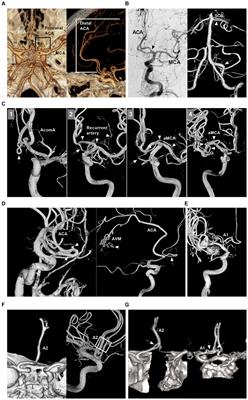 Current state of endovascular treatment of anterior cerebral artery aneurysms